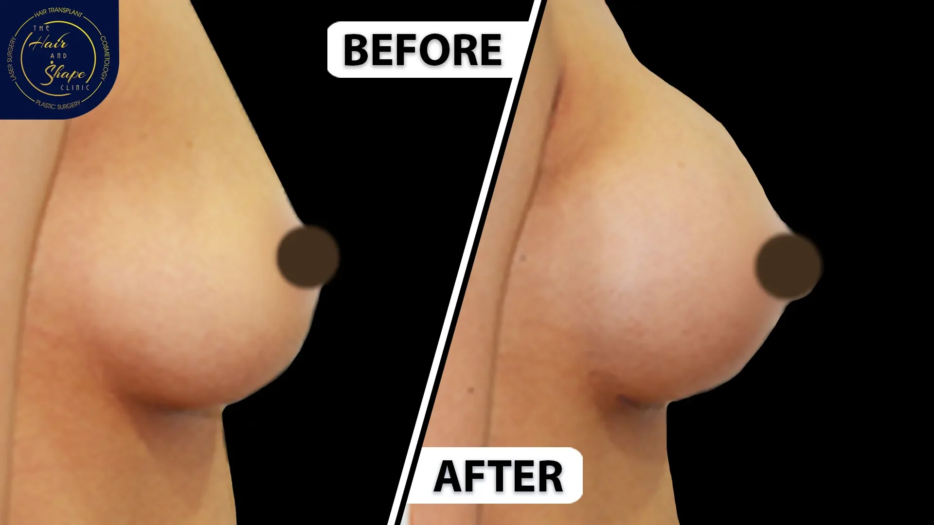 Breast Augmentation result8